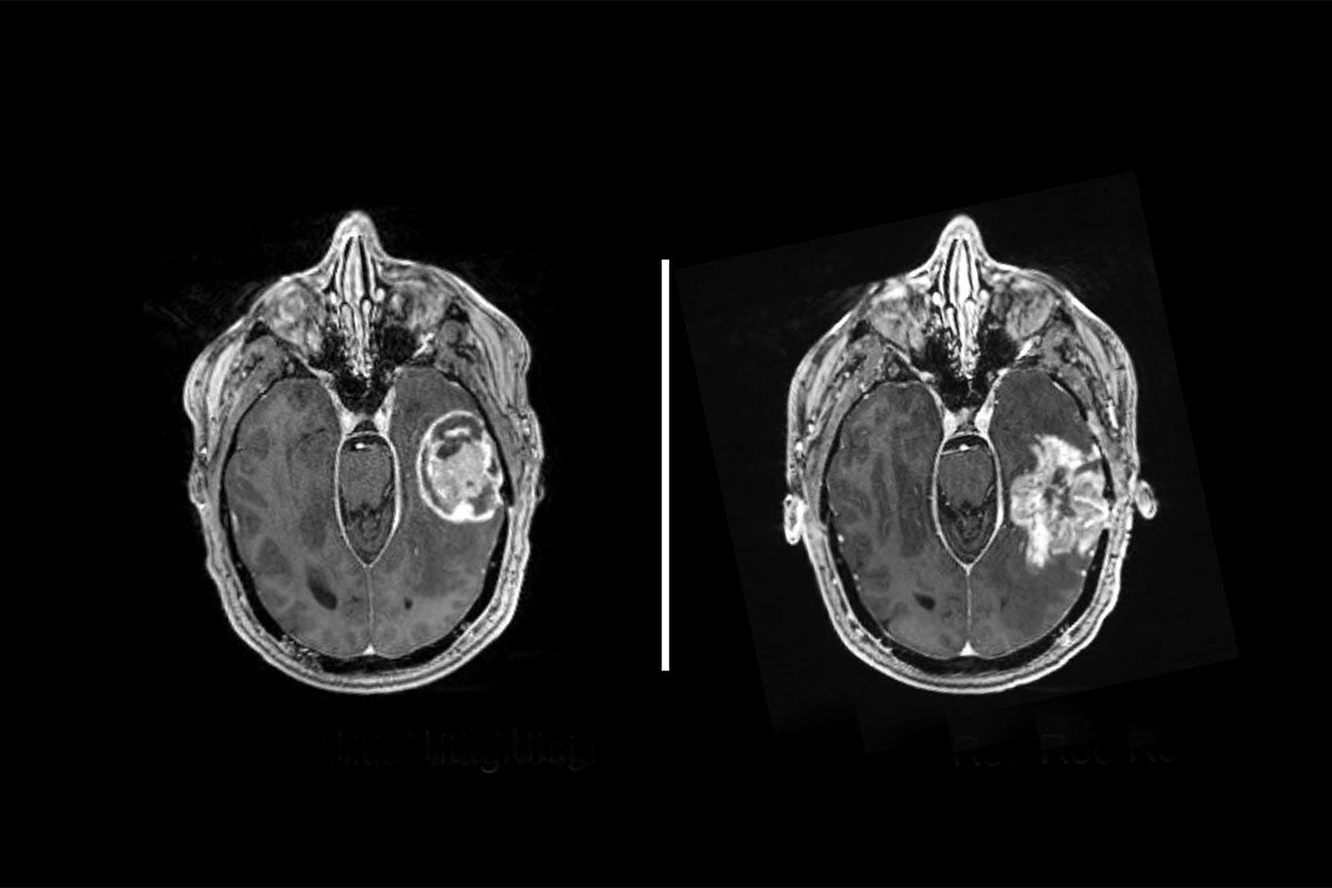 Ting Wang, PhD and researchers have identified a possible way to make glioblastoma cells vulnerable to different types of immunotherapy